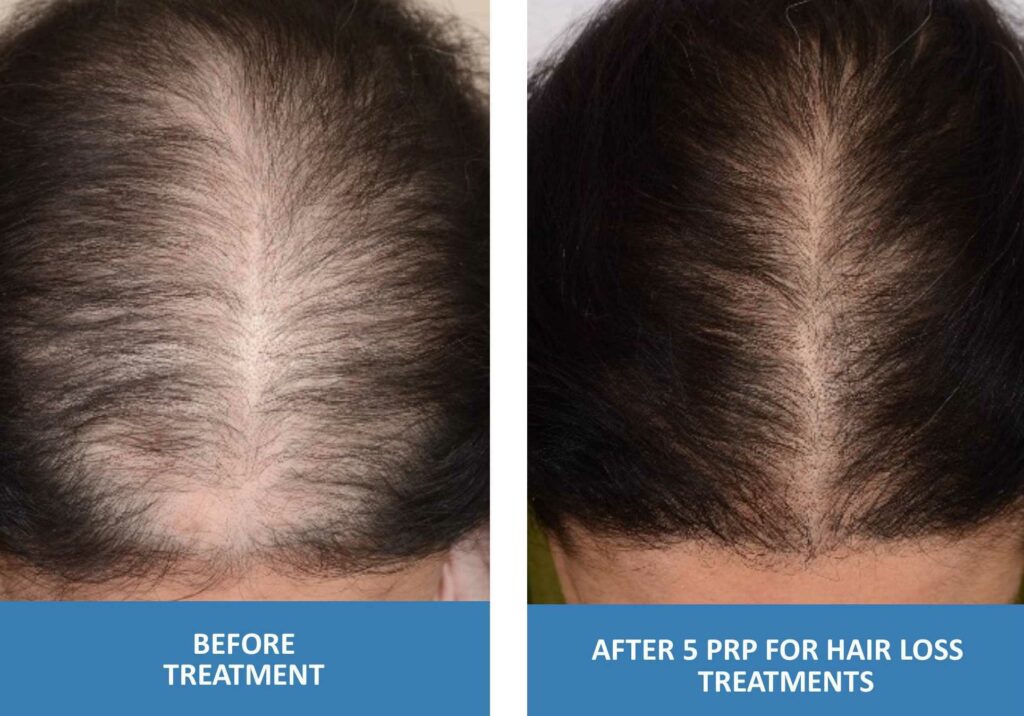 PRP Before and After