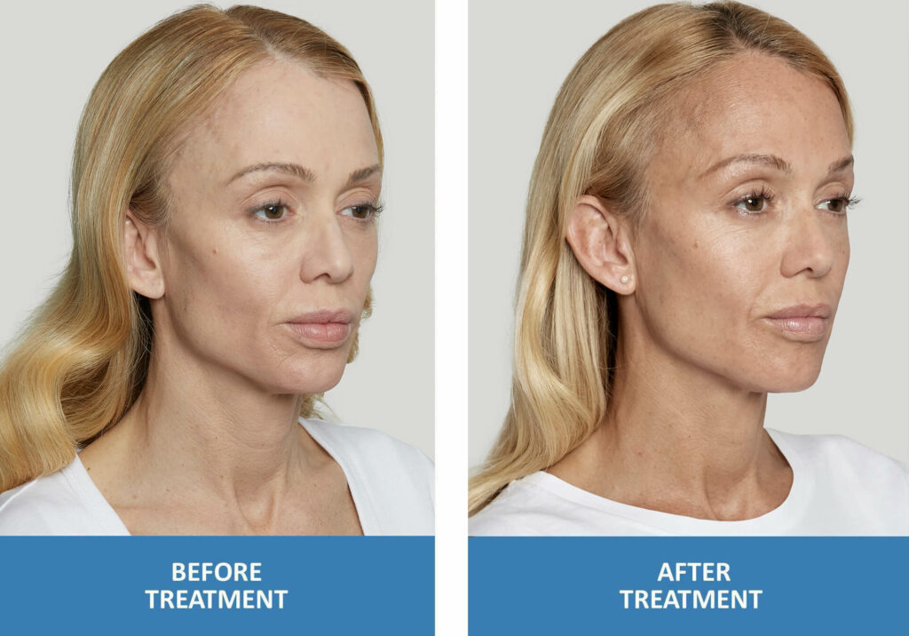 Sculptra Before and After